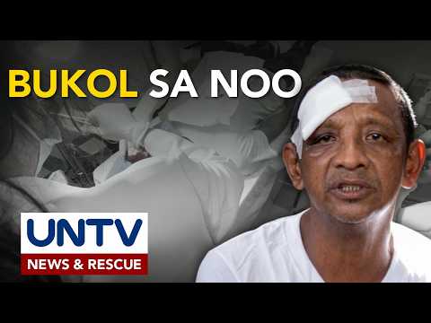 Padre de pamilya mula Cavite, naoperahan ang bukol sa noo sa tulong ng Serbisyong MCGI
