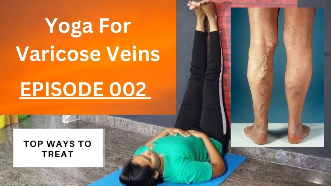 Yoga for Varicose Veins | Vein Treatment Maryland | The Vein Center