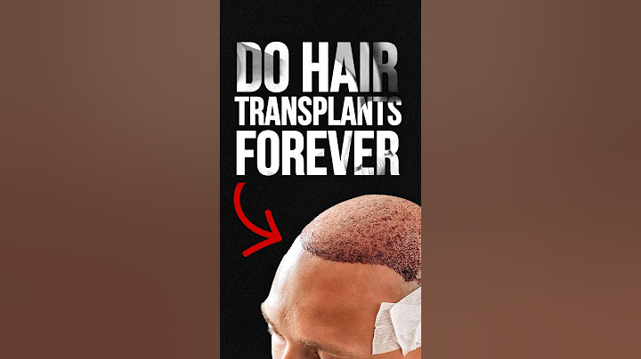 Do Hair Transplants Last Forever? #hairtransplant
