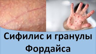 Сифилис и гранулы Фордайса