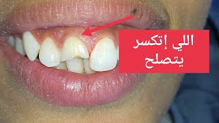 روعة حشو الليزر مع تركيب دعامة للسن الأمامي|| post&core ll composite restoration