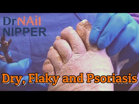 📍 What is Psoriasis? with a P ✨ Dr Nail Nipper Explains (2021)