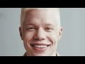 Albinism research at the national eye institute aman george