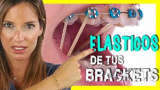 ELASTICOS INTERMAXILARES para asentar MORDIDA  Para que sirven las GOMAS de los BRACKETS