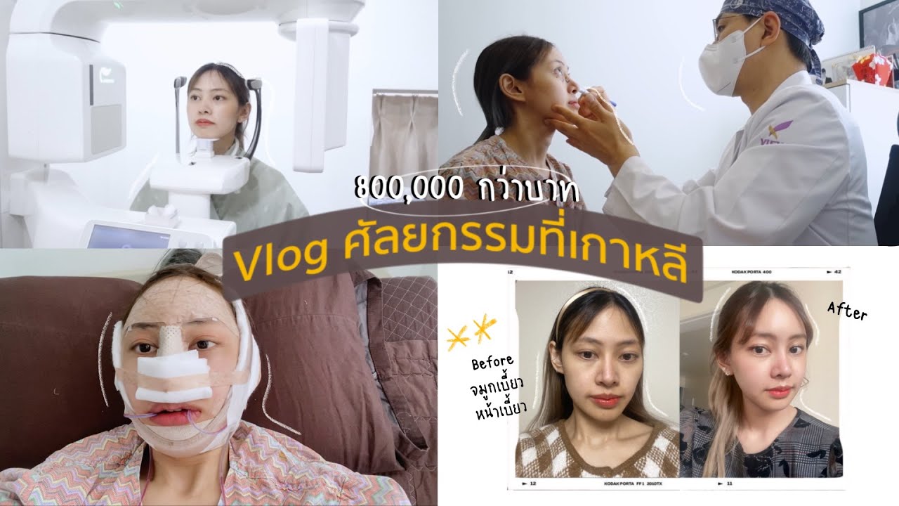 เสริม จมูก ทรง เกาหลี  Update New  Vlog ✨Plastic Surgery in Korea✨ แก้จมูก, ทำโครงหน้า ก่อน-หลัง แบบละเอียดกันไปเล้ย