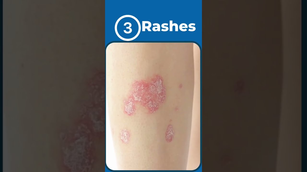 5 Signs Of Autoimmune Disease Rheumatoidarthritis Lupus Psoriaticarthritis Autoimmunedisease