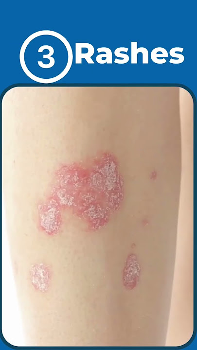 5 Signs of Autoimmune Disease #rheumatoidarthritis #lupus #psoriaticarthritis #autoimmunedisease