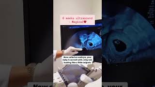 6 weeks pregnancy ultrasound scan.#ultrasound #pregnancy #sonography