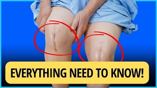 Knee Replacement: A Real Patient Tells You What You Need to Know.