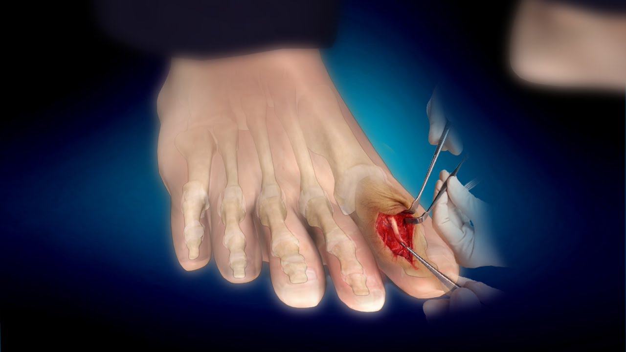 Broken Toe or Fractured Toe: Treatment, Symptoms, Prognosis - YouTube