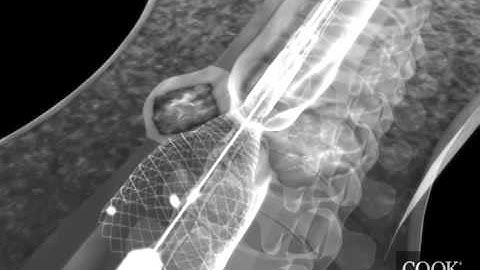 Evolution® Esophageal Controlled-Release Stent – Partially/Fully Covered Fluoroscopic Animation