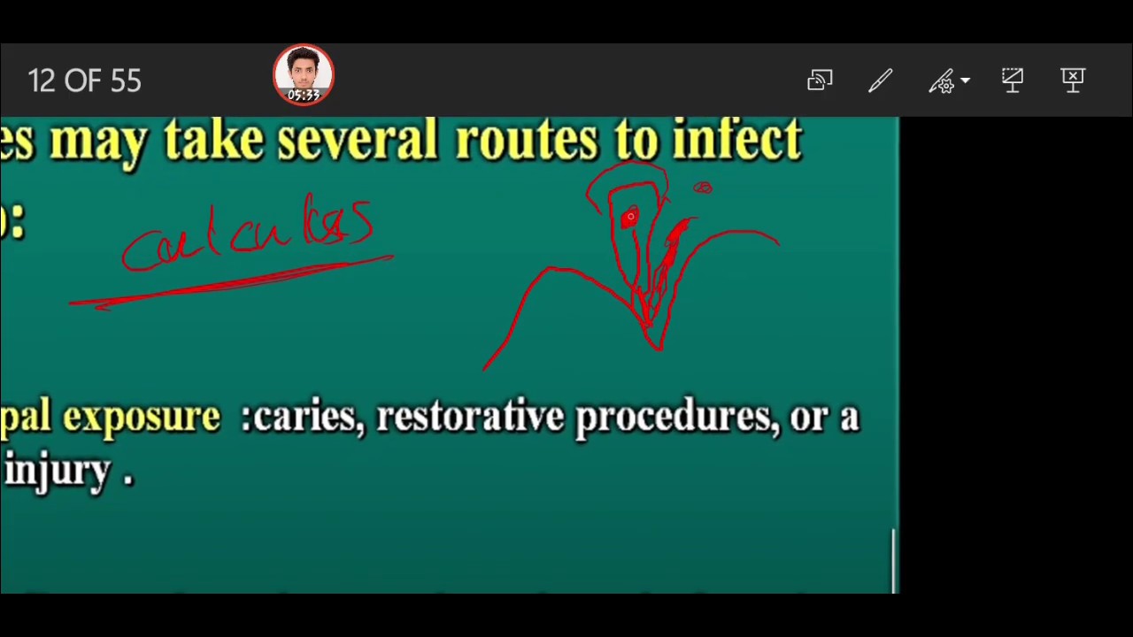 endodontic lecture 2 _ pulp and periapical pathosis part 2 YouTube