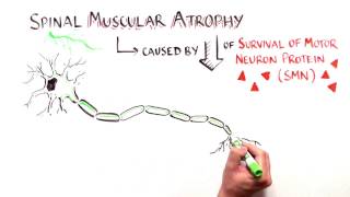 Cut and Paste: Treating Spinal Muscular Atrophy with Nusinersen