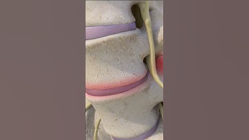 L4-L5 Degenerative Spondylolisthesis
