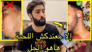 هذا هو العلاج الوحيد للتساقط الشعر و إنبات اللحية   Minoxidil#