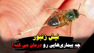 نیش زنبور چه بیماری‌های رو درمان میکنه؟