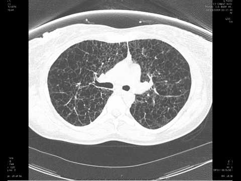 High-Resolution CT of the Lung 第5版 High-Resolution CT of the Lungs | AJR