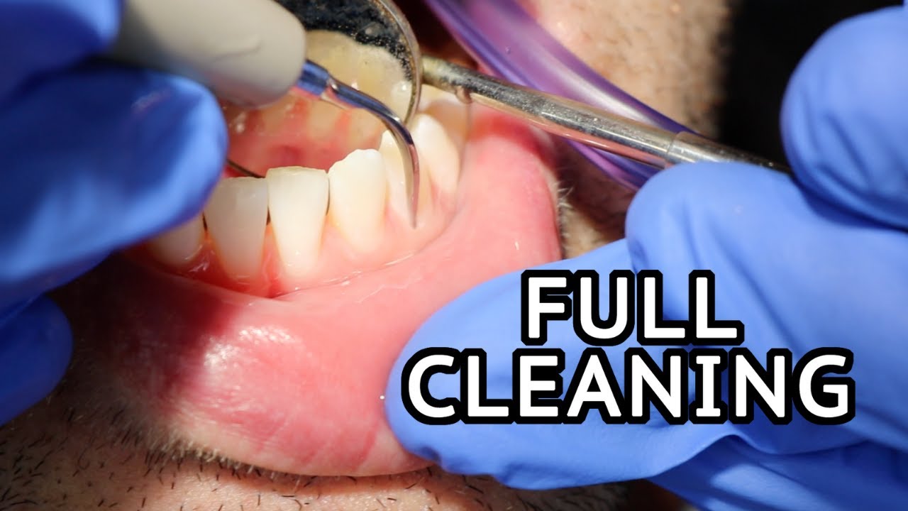 What Is the Difference Between a Routine Dental Cleaning and a Deep Cleaning?:  Rifkin Dental: Dentists