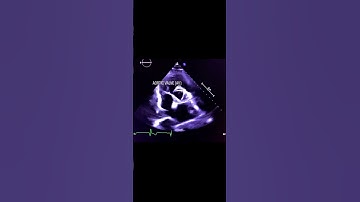 Parasternal Short Axis View #echocardiography #cardiology #echocardiogram