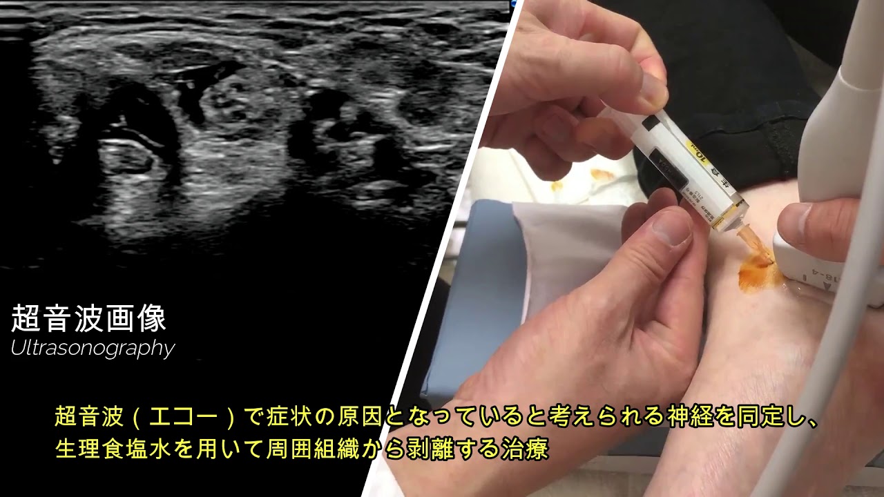 Hydrorelease 生理食塩水注射 Ar Ex スポーツ 難治性疼痛外来