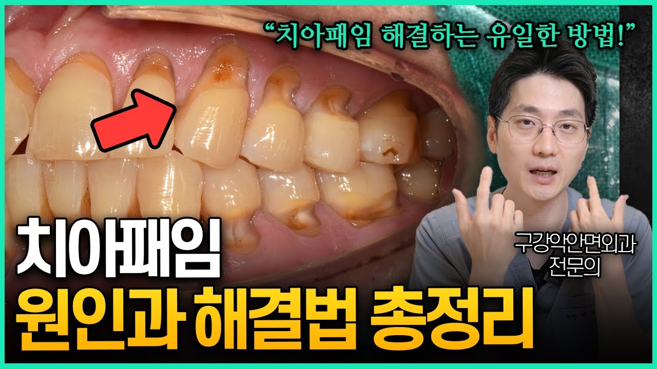 잇몸 내려간 치아패임 종류별 원인과 증상에 따른 해결법
