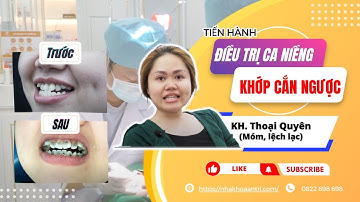 Tiến hành điều trị ca niềng khớp cắn ngược #niengrang #nhakhoaantri