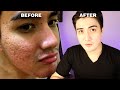 HOW I GOT RID OF MY ACNE SCARS? (Philippines 2021) ] Envi Beauty