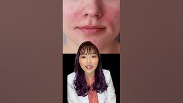 Thumbnail of 💛 TIPS SAAT ALERGI SKINCARE!! dr. Anita Ang