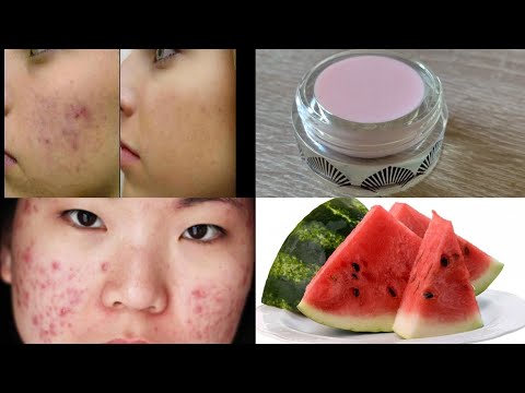 Vídeo: Com eliminar les taques de vernís de la pell