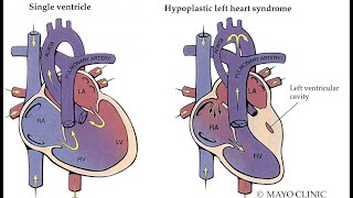 Mayo ClinicHypoplastic Left Heart Syndrome