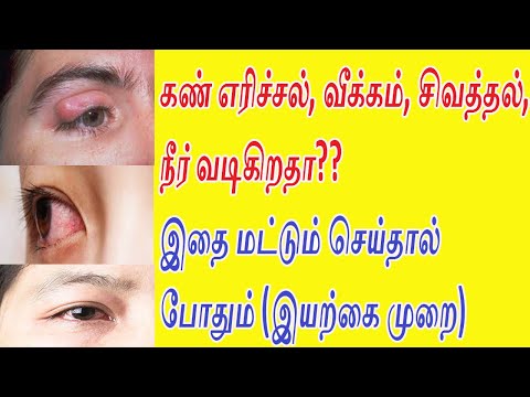 கண்களில் எரிச்சல், வீக்கம், சிவத்தல், நீர் வடிகிறதா?? இதை மட்டும் பண்ணுங்க