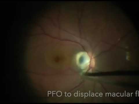 Royce Chen - Optic Pit with Inverted ILM Flap, Laser, and Drainage Retinotomy