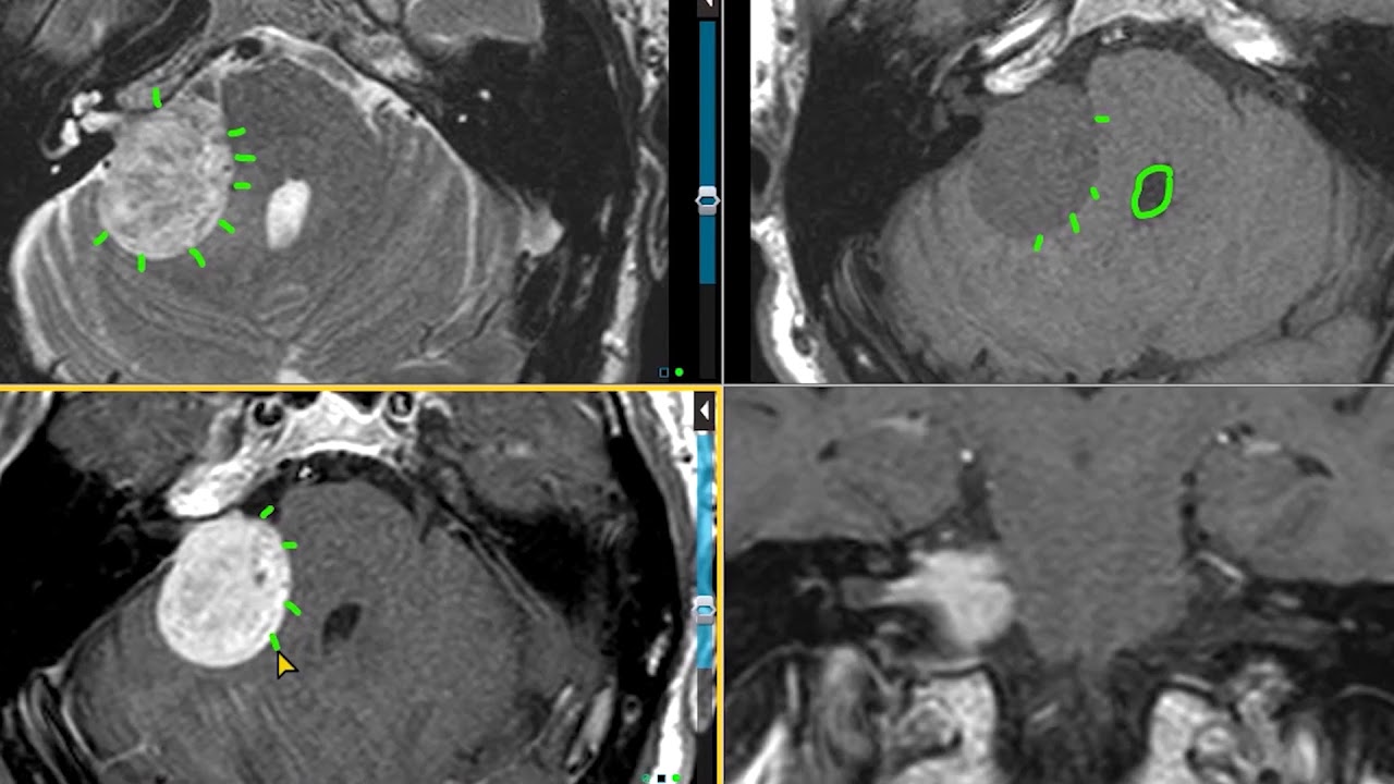 MRI Mastery Series CP Angle Masses Trailer YouTube mri-mastery-series-cp-angle-masses-trailer-youtube