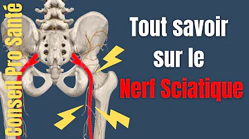 Quel sont les symptômes de la sciatique ?