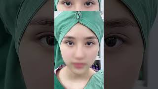 Double eyelid repair #Before and after plastic surgery #Eye comprehensive #Charming