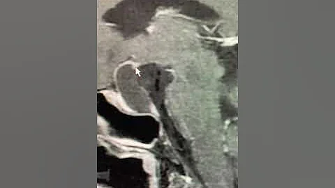 Rathkes Cleft Cyst