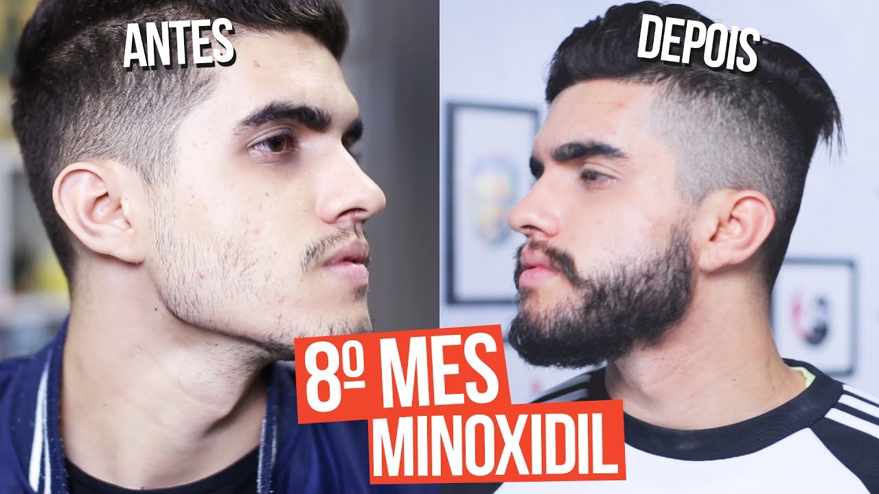 8 MESES COM MINOXIDIL - SAGA LENHADOR - YouTube