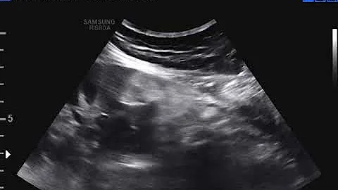 Come si opera un Angiomiolipoma?