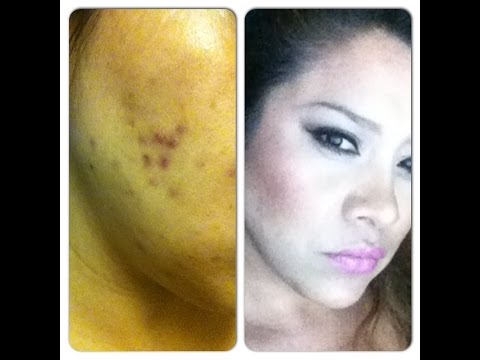  Productos que curaron mi acne