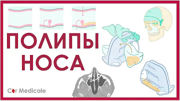 Полипы носа - что такое, причины, методы лечения - кратко