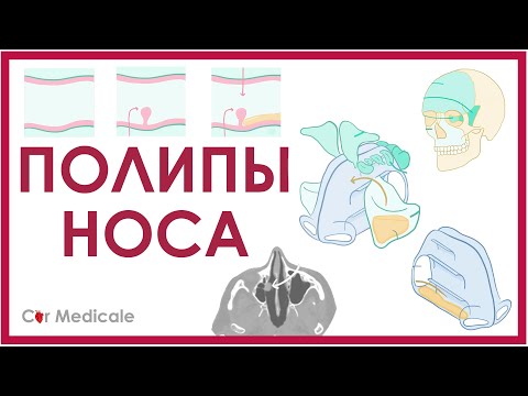 Видео: Полипи в носа: симптоми, лечение, причини, снимка