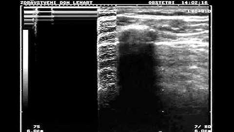 Normal lung vs. pneumothorax