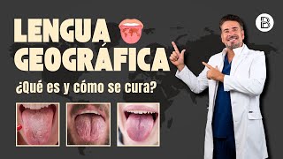 Lengua Geográfica: Causas, Síntomas y Tratamientos | ¿Es Grave? 🤔👅