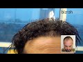 نتائج زراعة الشعر بعد سنه بزرة ميد دبي 