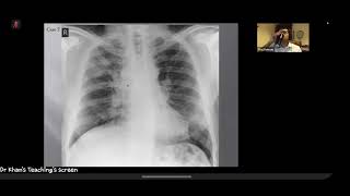 Radiology of Chest X-ray for FRCR Exam DKT Masterclass Part-1