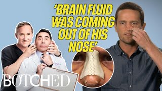 Famous Michael's FLAT Nose Collapsed After Botched Nose Job (Before & After) | Botched | E! Profile