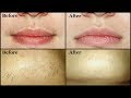 Remove UNWANTED UPPER LIP HAIR & CHIN HAIR by yourself easily at home | Mamtha Nair