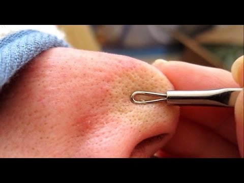 Image result for zit extractor