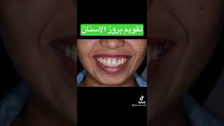 علاج ضب الاسنان - بروز الأسنان