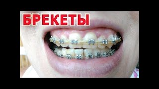 ★★ Брекеты. Сколько нужно носить и как действуют на зубы брекеты.